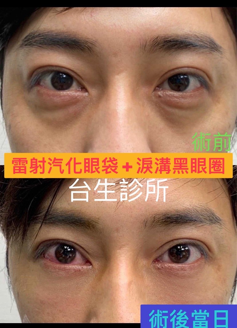 雷射汽化眼袋+黑眼圈淚溝術 - 