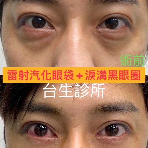 雷射汽化眼袋+黑眼圈淚溝術 - 