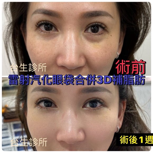 名藝人大美人林子瑄~術後一週~30分鐘雷射汽化眼袋合併3D補脂肪 - 