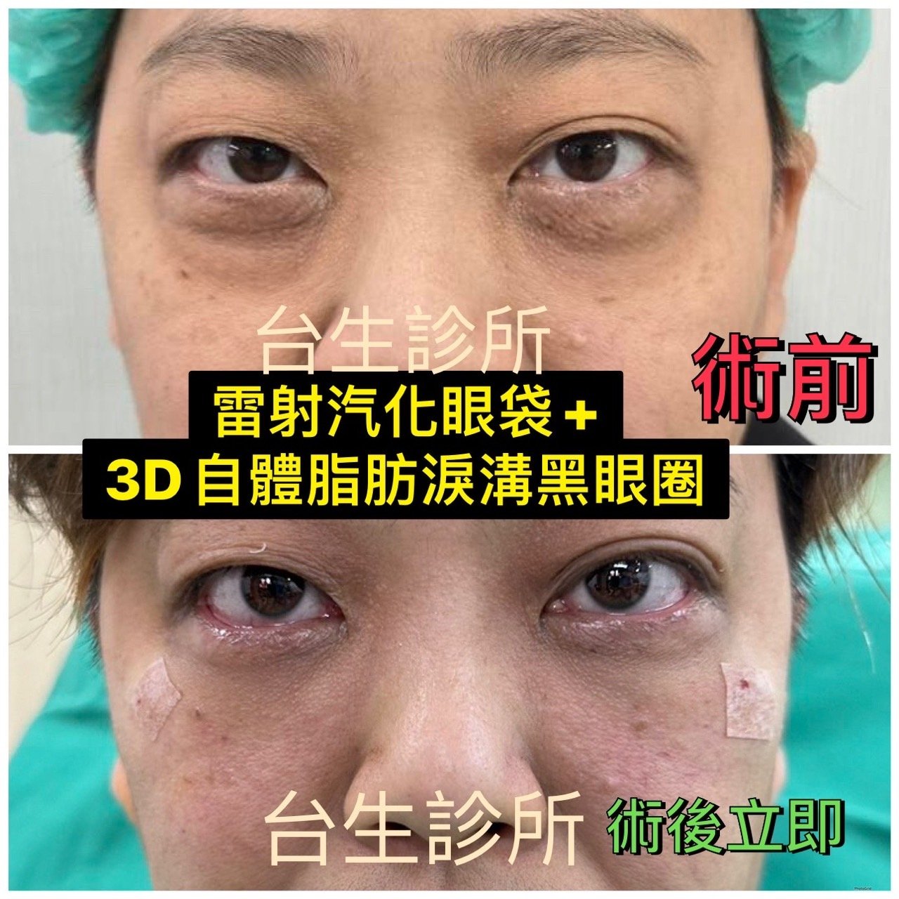 30分鐘雷射汽化眼袋+3D自體脂肪填補淚溝及黑眼圈 - 