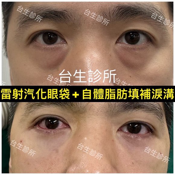 30分鐘雷射汽化眼袋+3D自體脂肪填補淚溝黑眼圈 - 