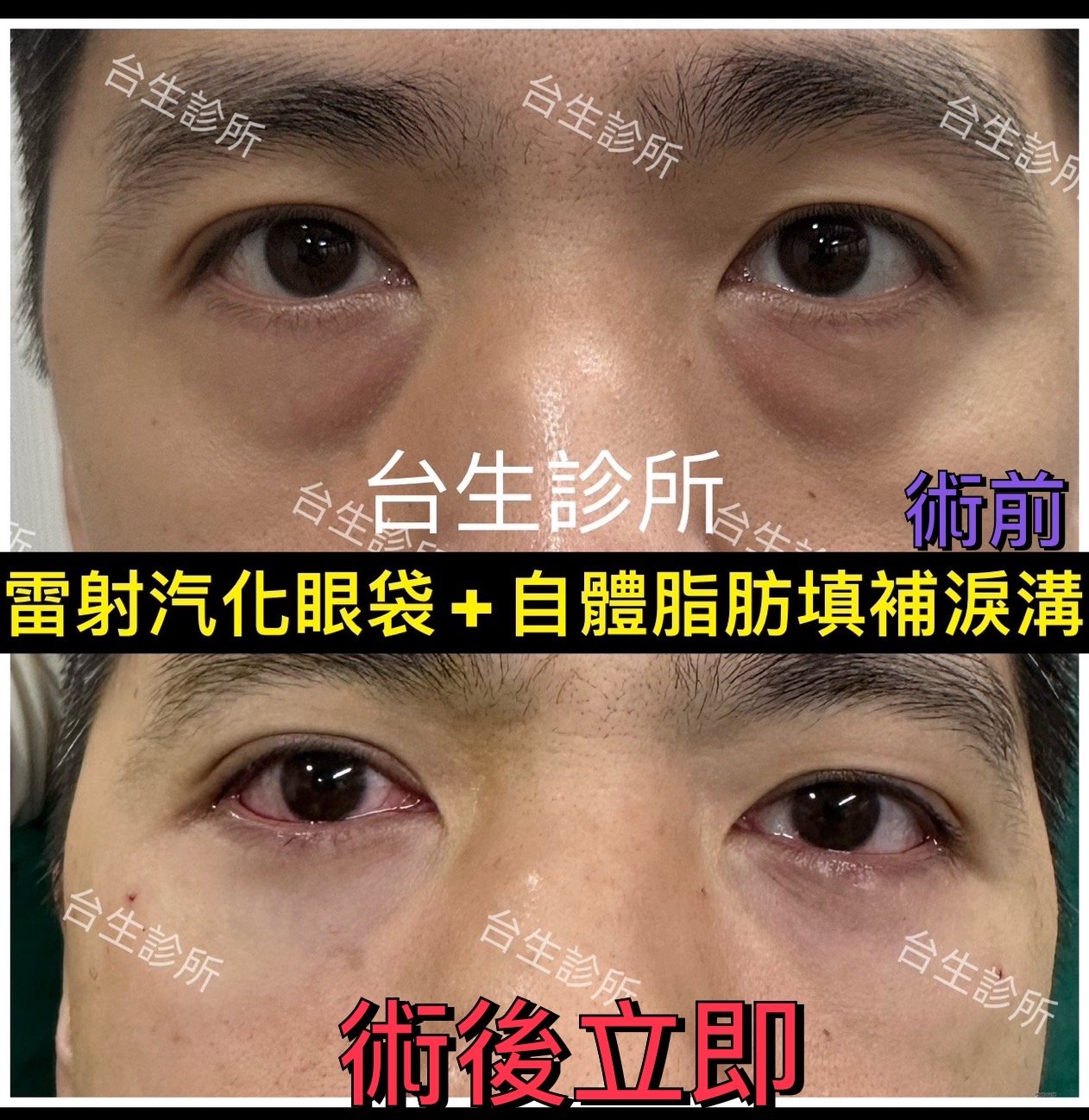 老態去除~30分鐘雷射汽化眼袋+3D自體脂肪填補淚溝黑眼圈 - 