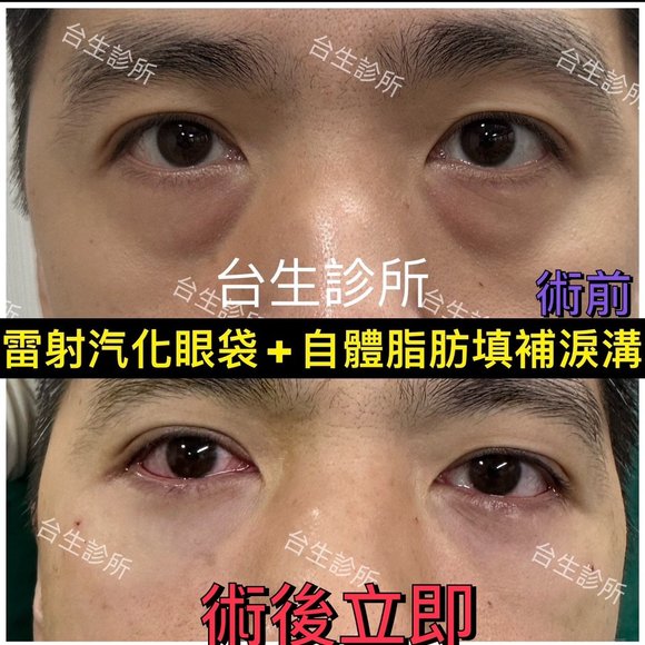 老態去除~30分鐘雷射汽化眼袋+3D自體脂肪填補淚溝黑眼圈 - 