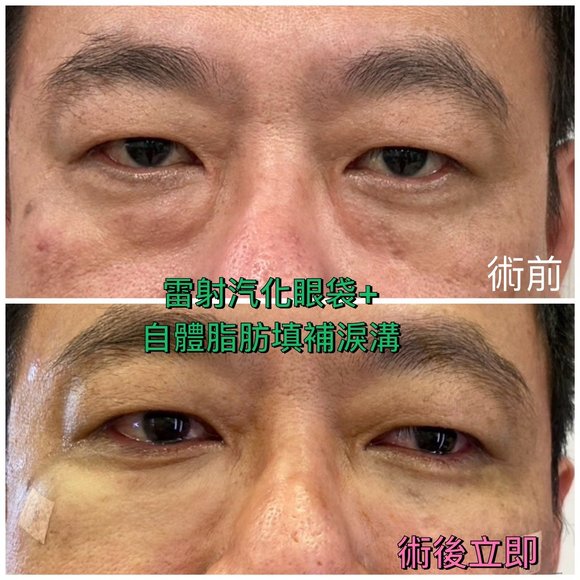 老態去除~30分鐘雷射汽化眼袋+3D自體脂肪填補淚溝黑眼圈 - 