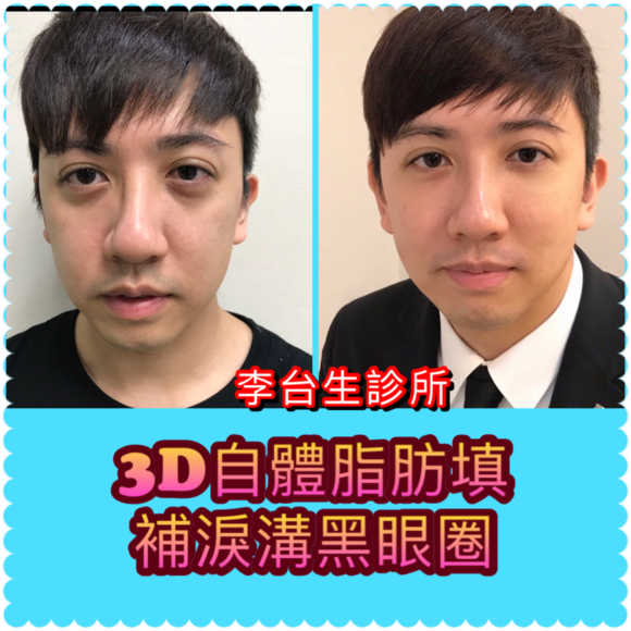 3D自體脂肪填補 - 